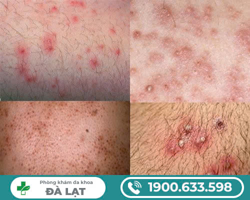 Nổi Mẩn Đỏ Ngứa Ở Bìu 